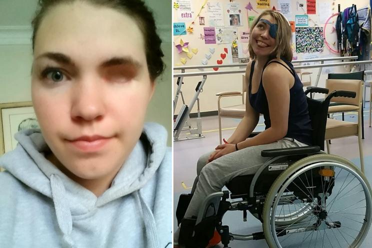 Jess Van Zeil after her cancerous eye was removed.