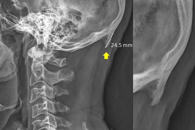 24.5mm external occipital protuberance