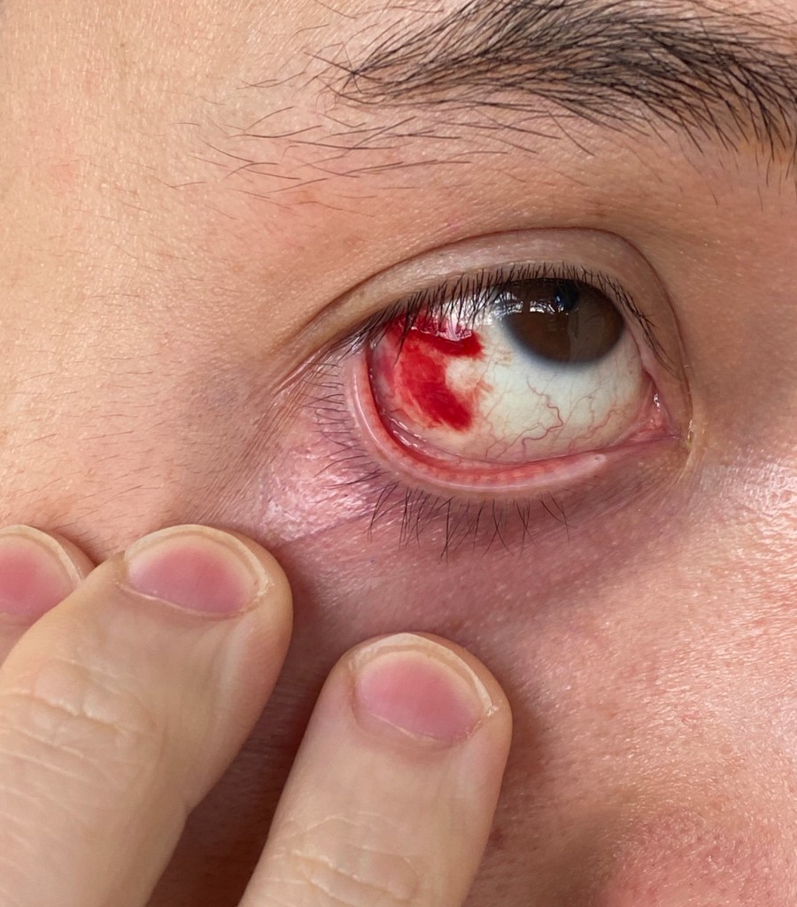 Andy Ngo's injuries from alleged attack.