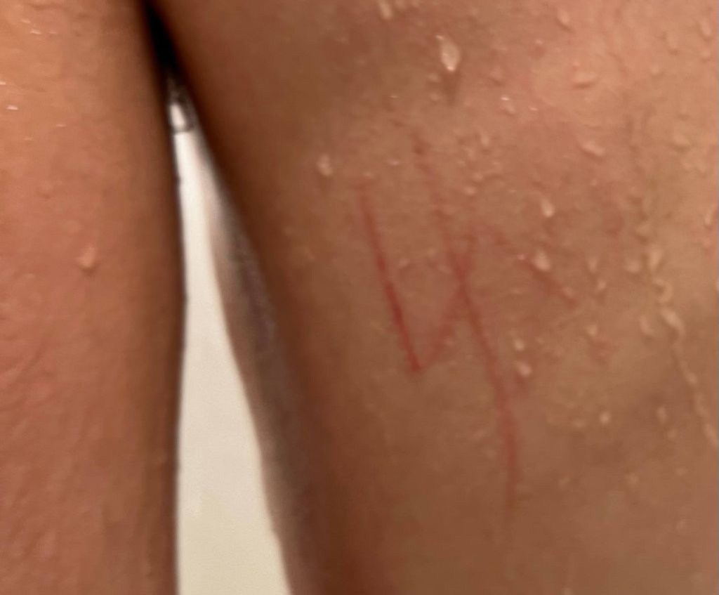 A 17-year-old autistic Jewish student at Clark High School in Las Vegas came home with a swastika carved on his back on March 9, prompting his mother to pull him from classes.