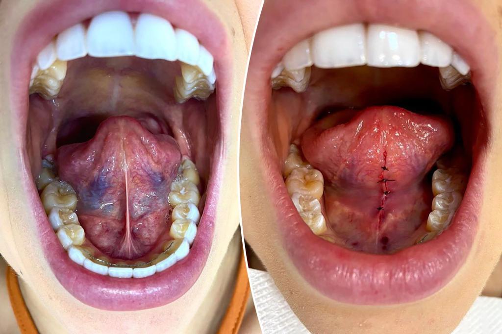 Rochelle Garett displays the before (left) and after of the removal of her lingual frenulum.