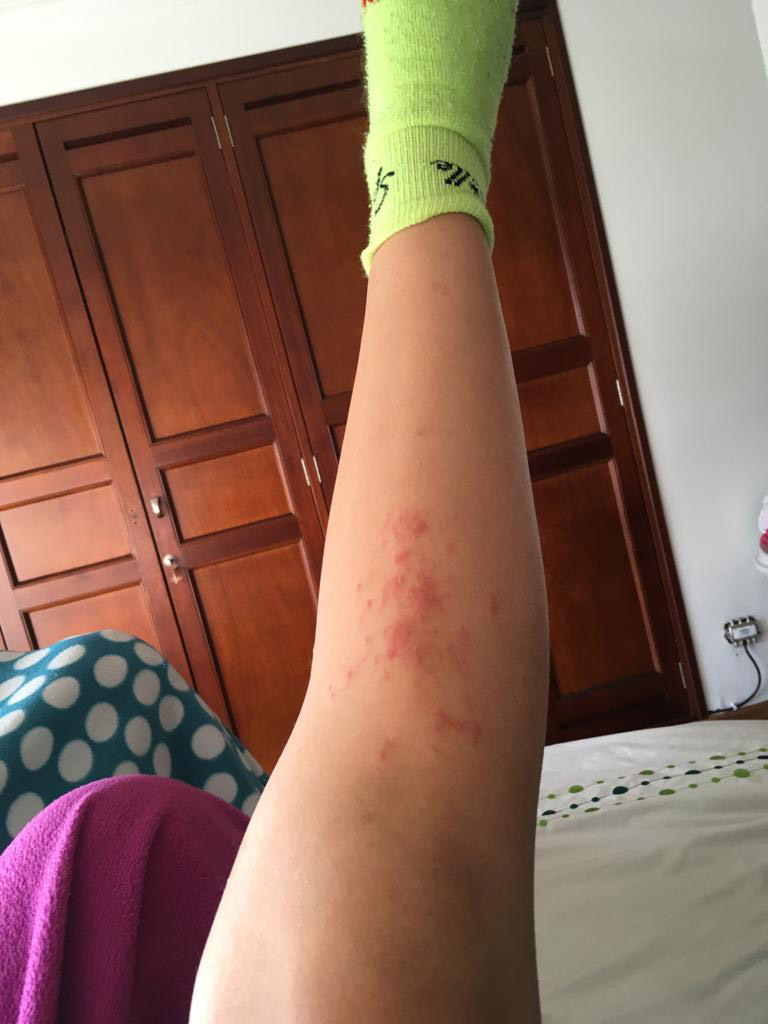 Gomez's parasite-infested leg.