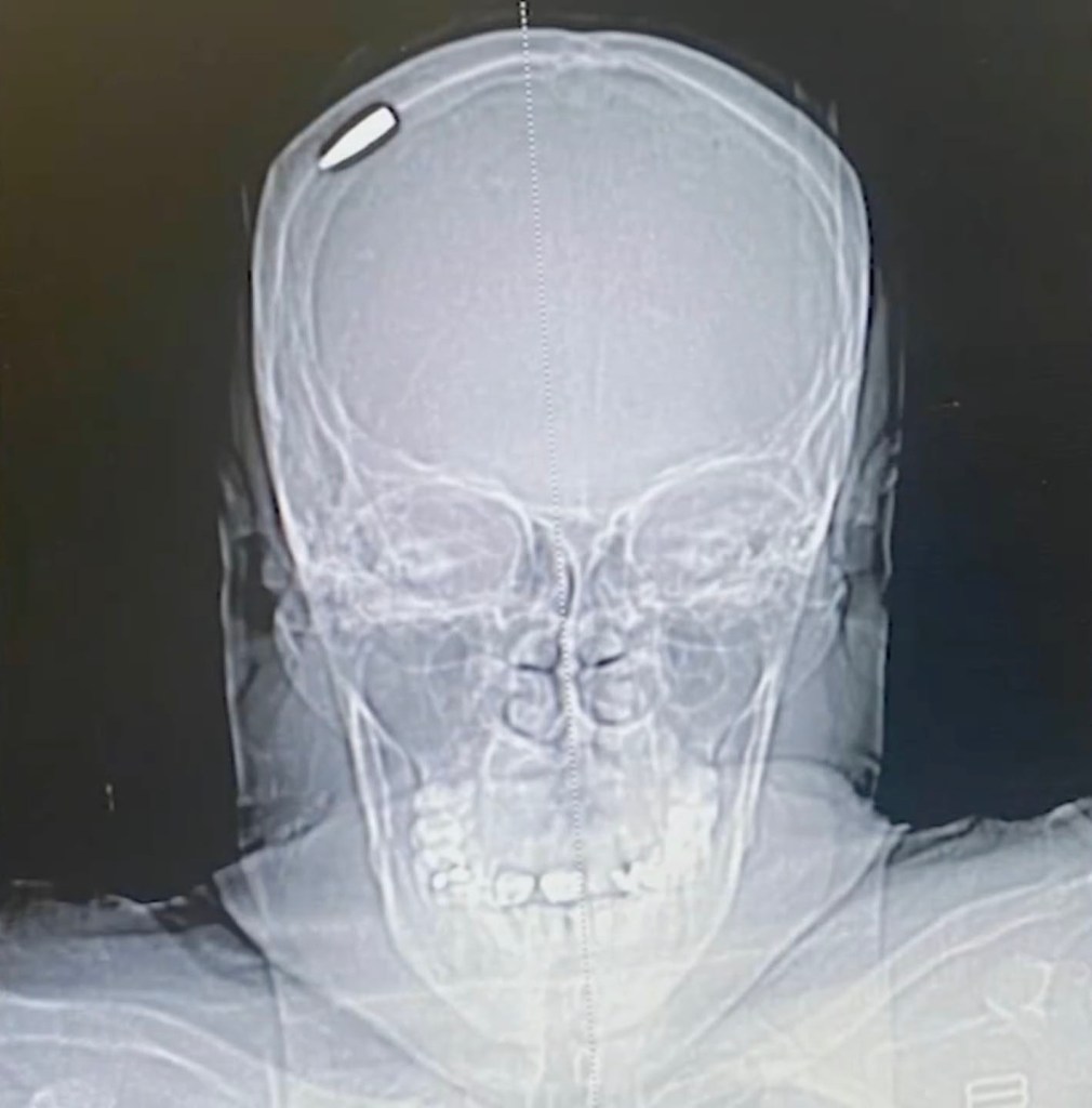 A CT scan shows a bullet lodged in Sabina Barajas' skull