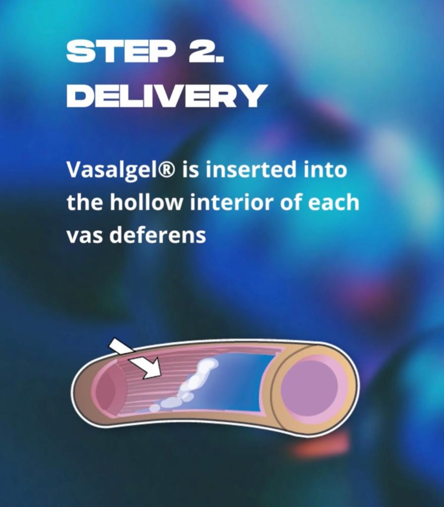 The doctor injects a hydrogel into the vas deferens -- the tube that carries seminal fluid.