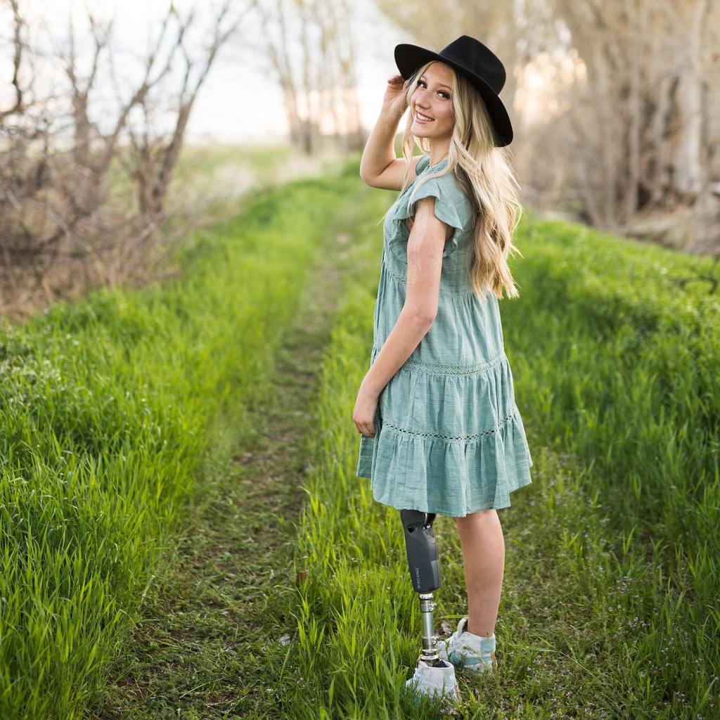 Littledike, now 19, poses for a photo with her new prosthetic leg.