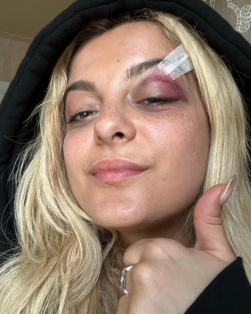 Bebe Rexha on stage with a bandage on her eye after being hit by a cellphone