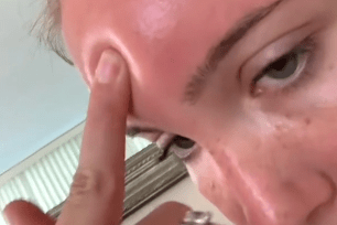 Woman’s skin puffs up from sunburn, leaves dent in forehead