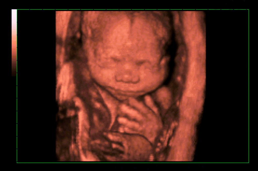 3d ultrasound