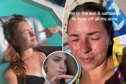 (Left) TikTok user and YouTuber LeooBayls sunburning. (Right) A TikTok user sunburning. (Inset) A woman noticing a zit.