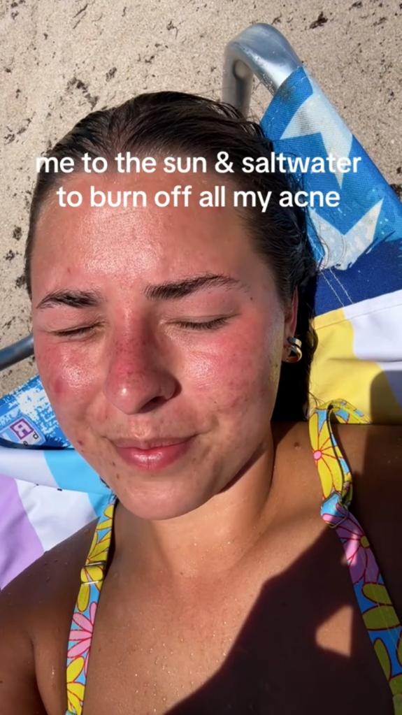 TikTok user participating in the sunburning trend. 