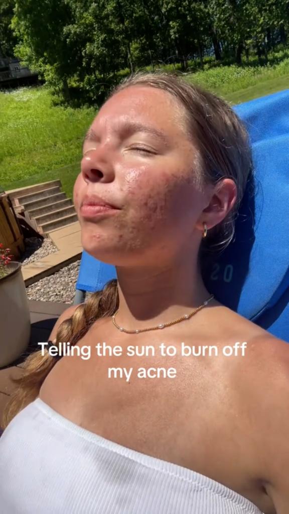 TikTok user Haley Wenthold, 19, participating in the sunburning trend. 