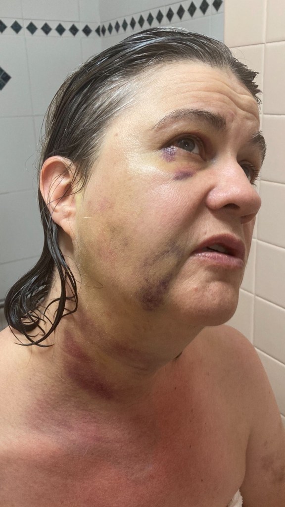 Keri Roy, 57, seen with bruises on her face and neck after a reckless moped rider rammed into her in mid-July.