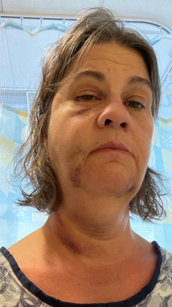 Keri Roy, 57, seen with bruises on her face and neck after a reckless moped rider rammed into her in mid-July.