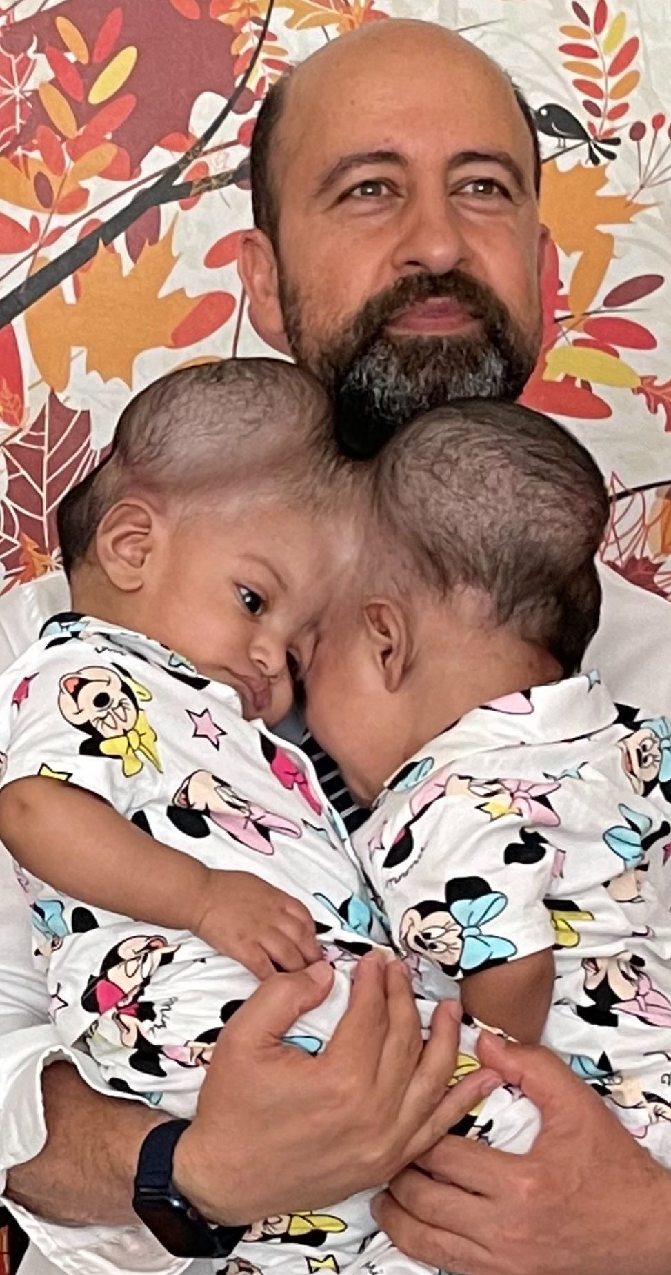 The girls are seen with Professor Jeelani prior to the surgery in July. The neurosurgeon has completed a number of other high-risk separation operations. 