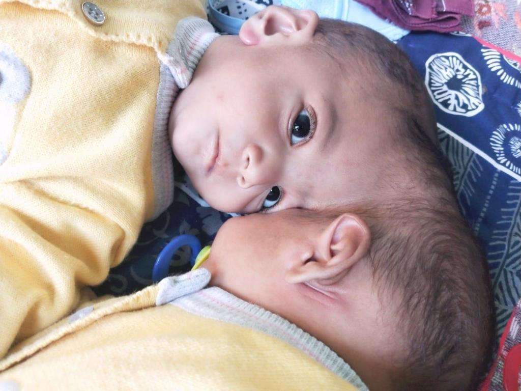 The twin girls, named Minal and Mirha, were born in Pakistan last year, sharing vital blood vessels and brain tissue that made a separation operation extremely high risk. 