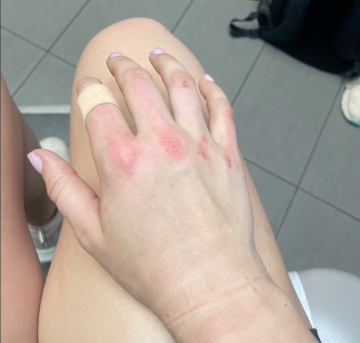 Image of Alexa Very's swollen and battered right hand after she punched down her attacker