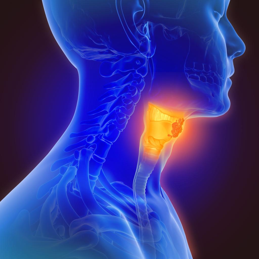 Oropharyngeal cancer strikes the middle portion of the throat behind the mouth.