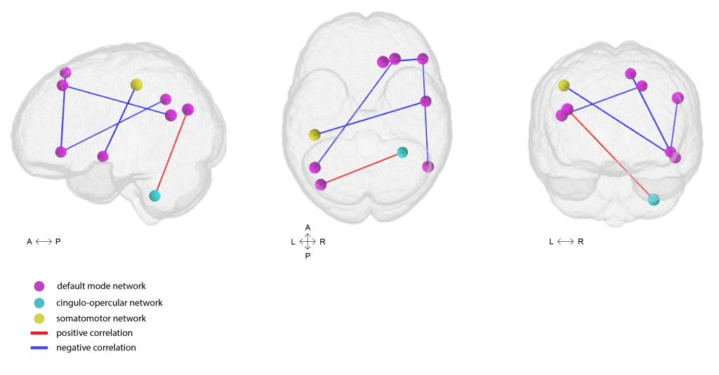 Restless sleep correlates with lower connectivity between default mode network nodes, a group of brain regions that are active when we are at rest, not focusing on any specific task.