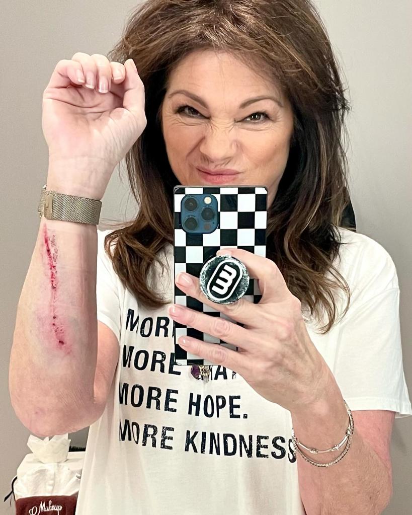Valerie Bertinelli shows off her cut on her arm
