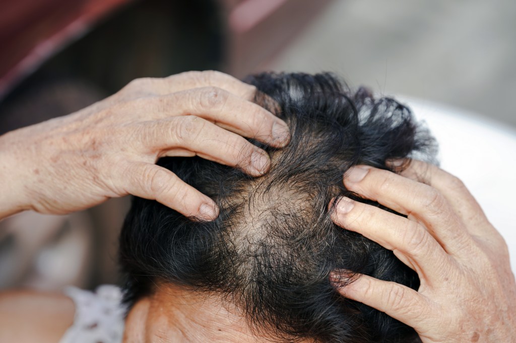 Intermittent fasting, praised for helping with weight loss, blood sugar and inflammation, could have a majorly unpleasant side effect — a new study finds that your hair may thin. Here, a older person shows their thinning hair.