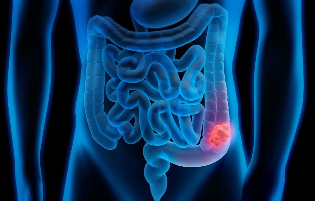3D medical illustration of a large intestine affected by colorectal cancer polyp