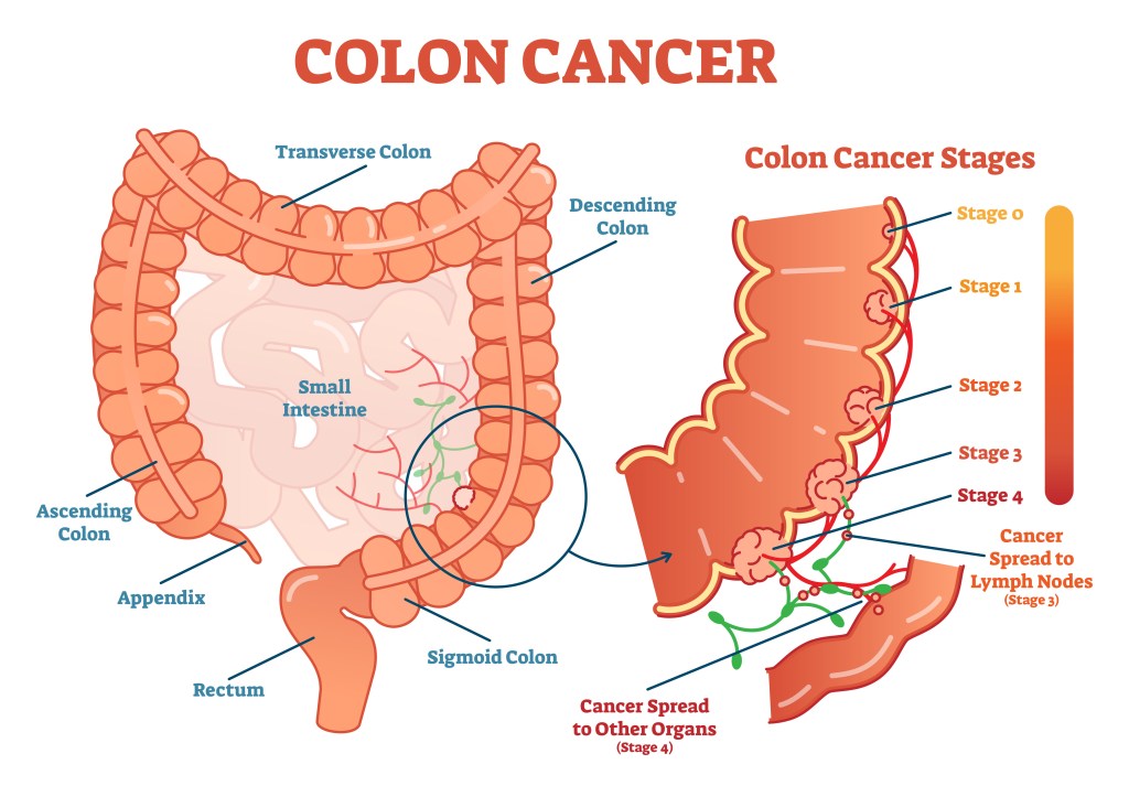 colon cancer medical vector 