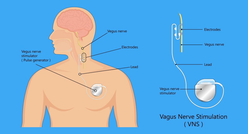 There are two types of vagus nerve stimulators — an implantable device (shown here) and a non-invasive device that the user places on the neck or ear.