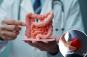 'Significantly higher' risk of early-onset colorectal cancer for 80M+ Americans with this 'hidden' disease