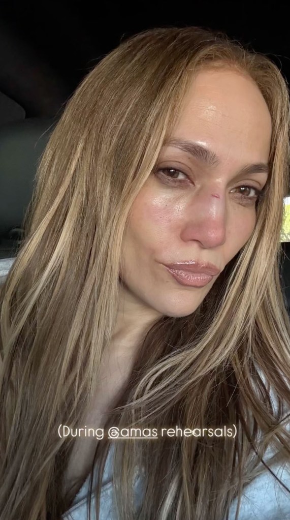 Jennifer Lopez shows off her facial injury