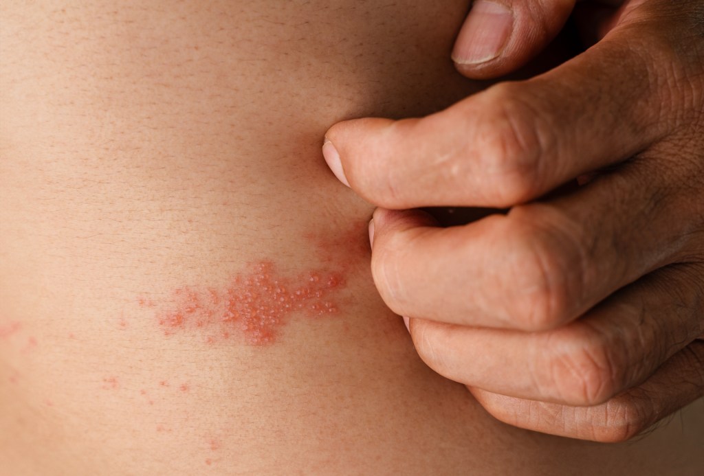 Shingles is most common in older adults, people with weakened immune systems and those who've had chickenpox. The shingles rash is seen here.