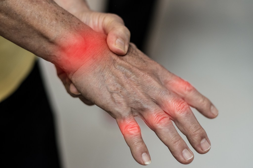 VNS may improve rheumatoid arthritis (shown here), a chronic autoimmune disease that causes joint inflammation and pain.