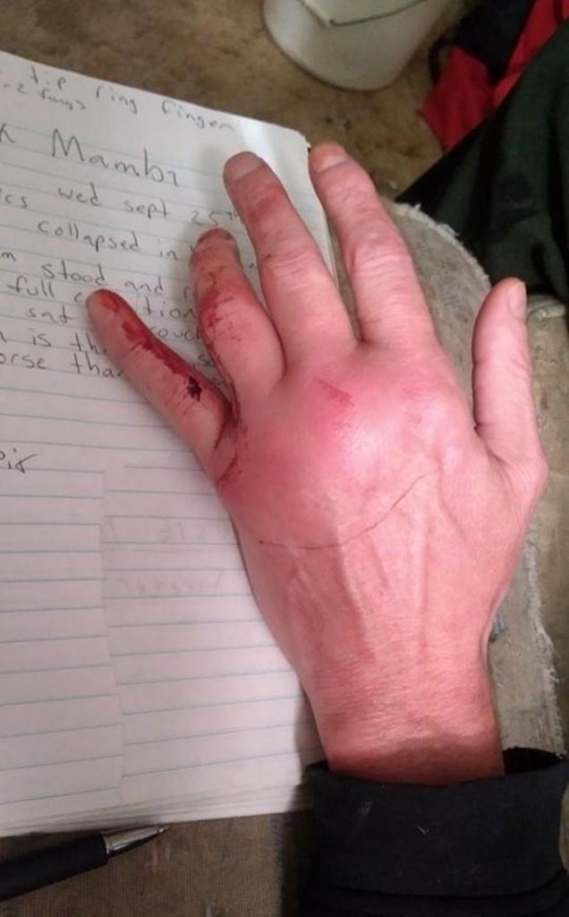 A photo showing Friede's swollen, bloody hand, after he was bitten by a snake,