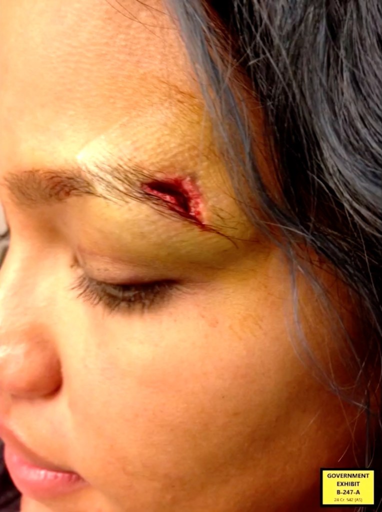 Close-up of a woman's forehead showing a cut and bruise.